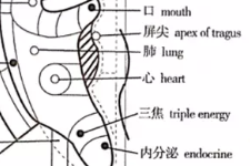 糖尿病的耳穴治疗