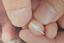 儿童湿疹，关键还是脾的问题