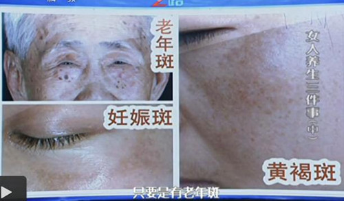 老年人为什么容易长班 老年人为什么容易长班