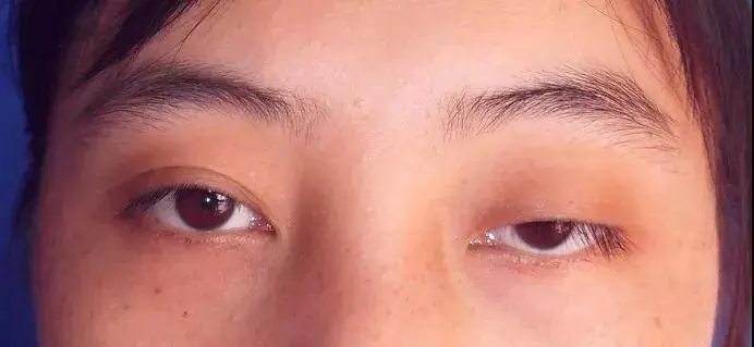 上眼皮松弛下垂显憔悴，教你一个简单手法，眼部紧致有光泽