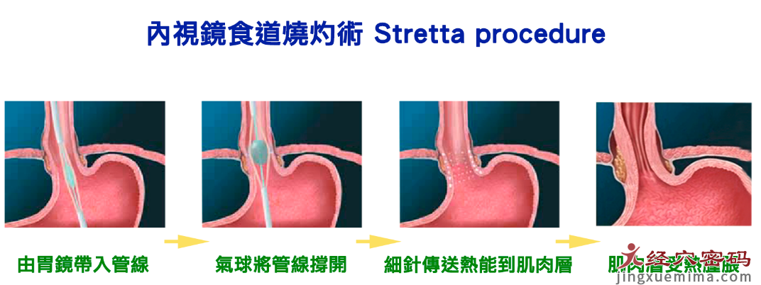 学员分享：胃食管反流的中医治疗方法及思考