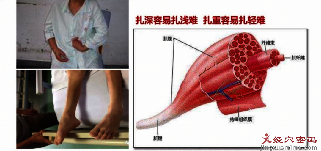 中风后遗症