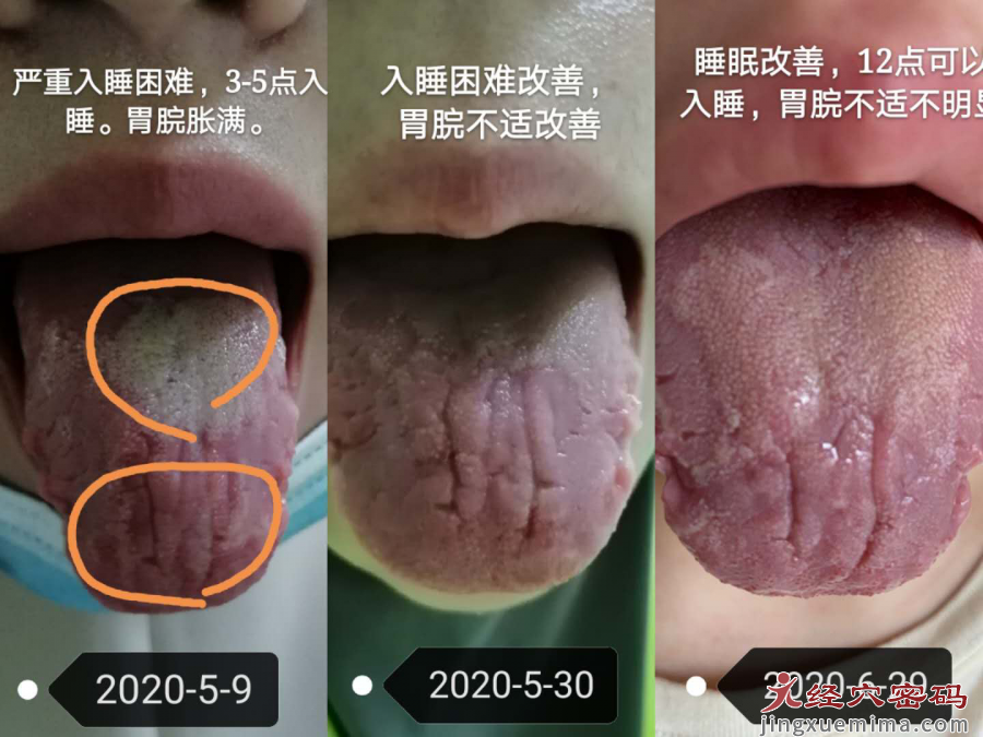 针灸后每晚睡前哭20分钟才能好好入睡，这是怎么回事?