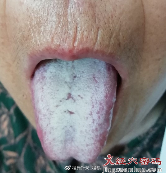 口周见到这样的纹，提示胃粘膜受损严重！