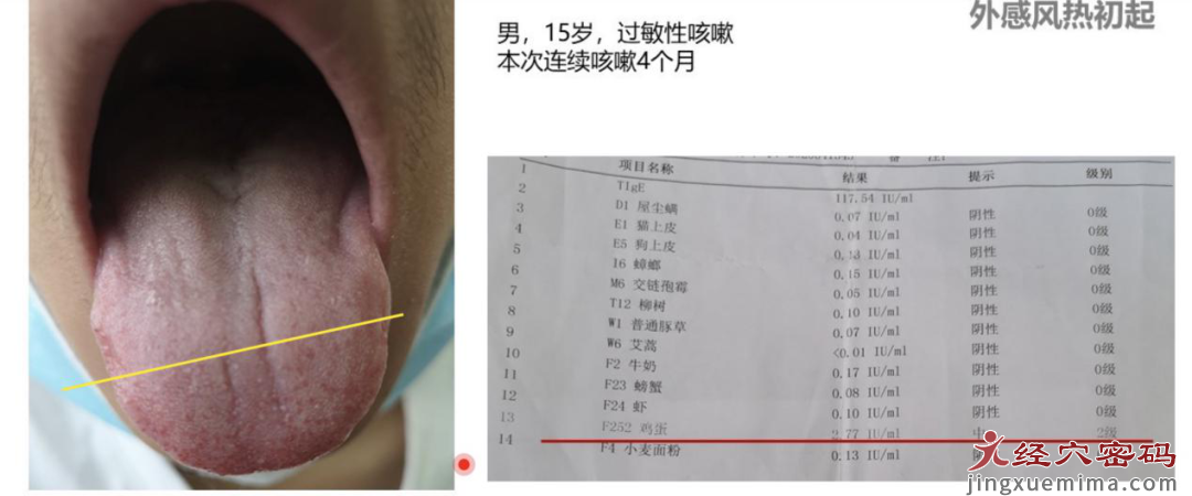 从几个病例看懂“红舌”的特征和临床意义