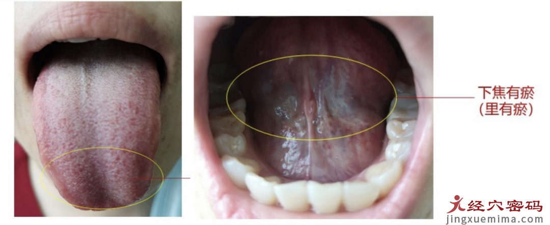 从几个病例看懂“红舌”的特征和临床意义