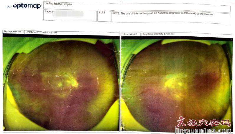 视网膜修复术后，针灸促进黄斑裂孔闭合医案一则